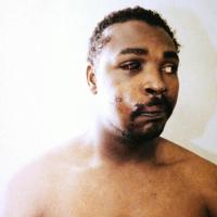 Rodney King post-beating and arrest